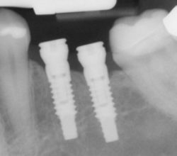 Dental implant root